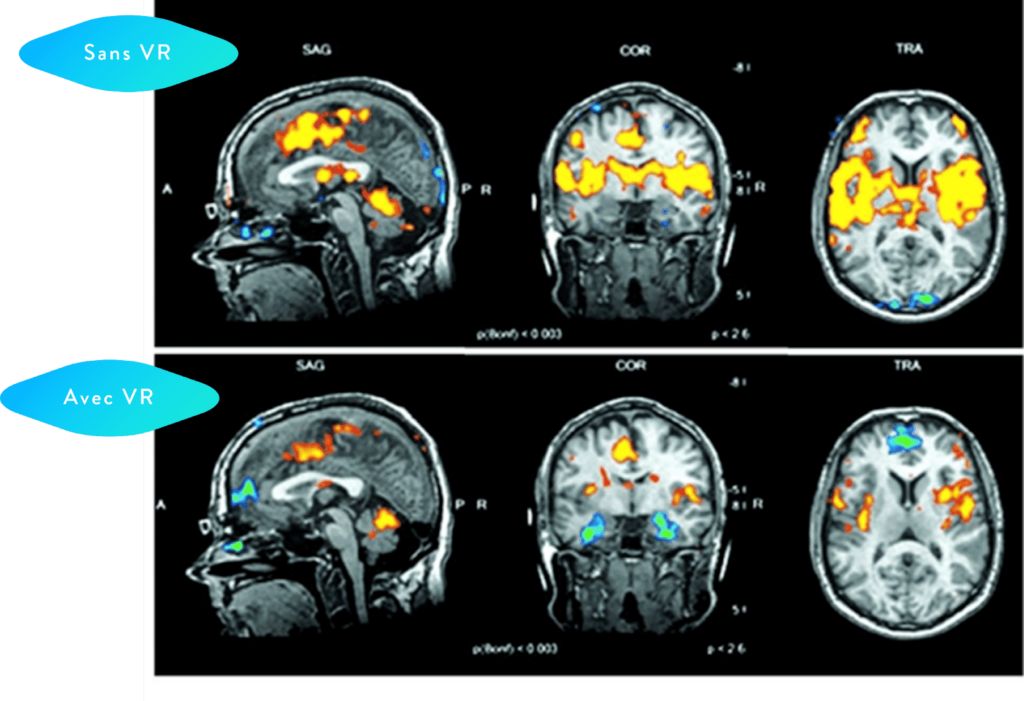 IRM fonctionnelle de l'activité d'un cerveau avec et sans réalité virtuelle.